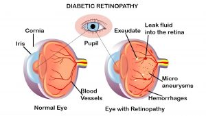 Retinal Disease