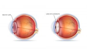 Cataracts