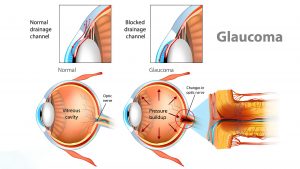Glaucoma