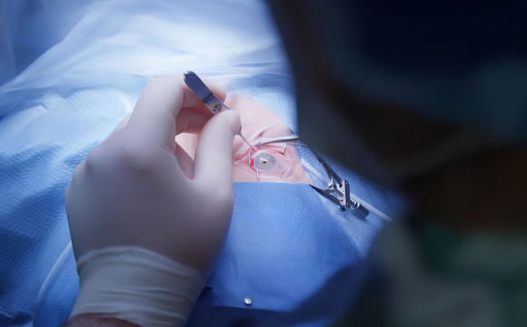Pterygium