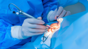 Cataract Surgery