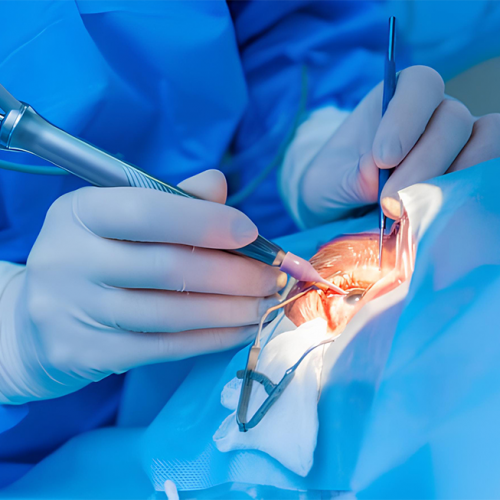 Cataract Surgery