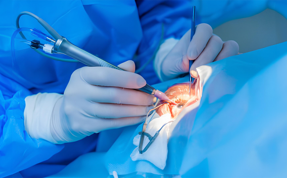 Cataract Surgery