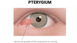 Pterygium